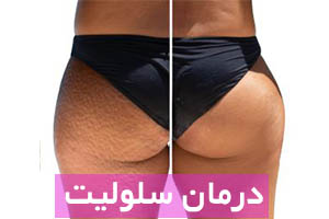 سلولیت چیست ؟ اسکین مال